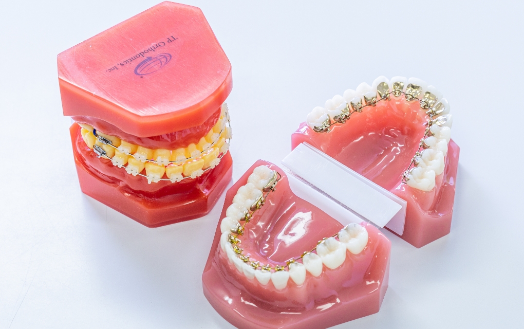 歯科矯正のイメージ