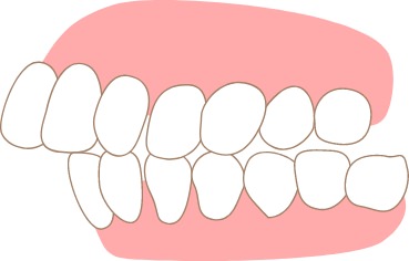 上顎前突（出っ歯）のイメージ