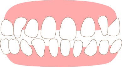 空隙歯列（すきっ歯）のイメージ