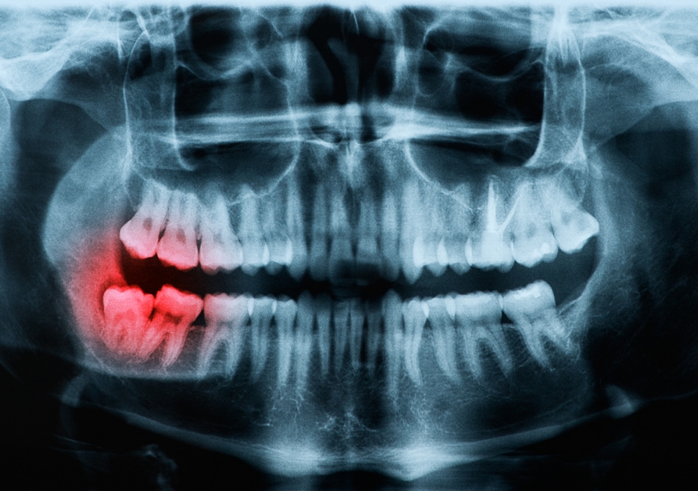 歯周病のレントゲン